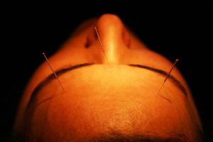 Akupunkturbehandlung auf Stirn