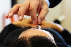 Akupunkturbehandlung: Nadeln werden gesetzt